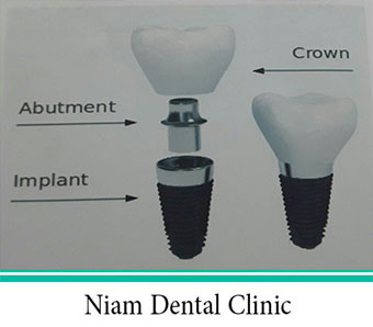 اجزای تشکیل دهنده ایمپلنت