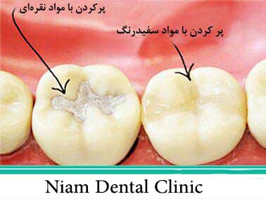 پرکردن دندان